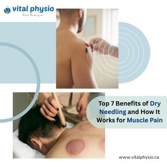 Top 7 Benefits of Dry Needling and How It Works for Muscle Pain