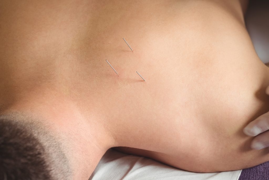 dry needling